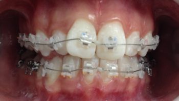 самолигирующие брекеты саратов