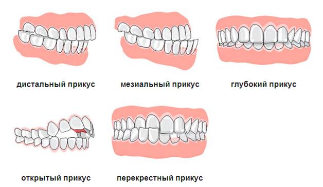неправильный прикус виды