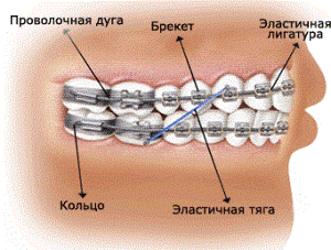 части брекет-системы