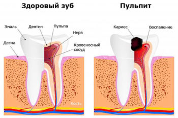 кариес фото на зубах