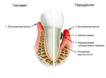 кровоточат десны что делать