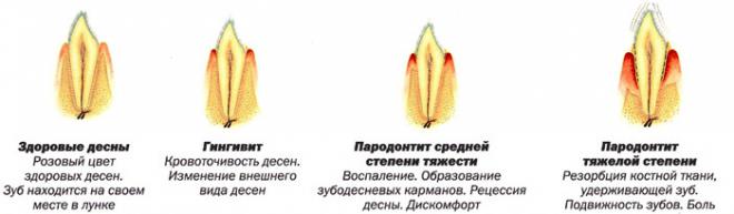 болит десна что делать