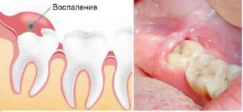 воспаление зуба мудрости