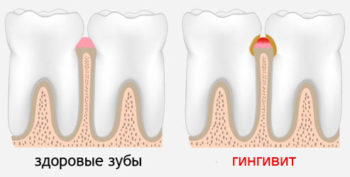 лечение гингивита в саратове