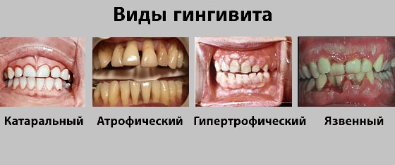 виды гингивита у детей и взрослых